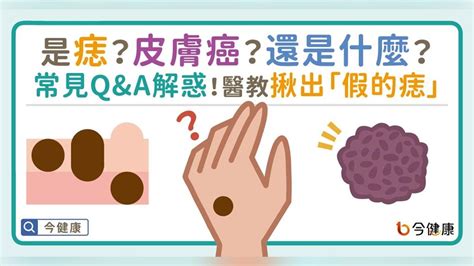 紅色的痣代表什麼|是痣？皮膚癌？還是什麼？常見Q&A解惑！醫教揪出「。